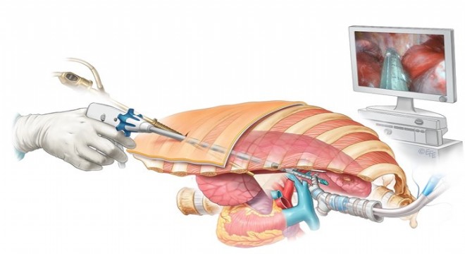 Ülkemizde her yıl 40 bin kişi bu hastalıkla tanışıyor